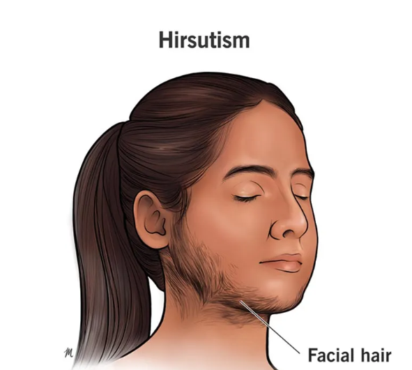 woman with facial hair showing the sign of hirsutism.